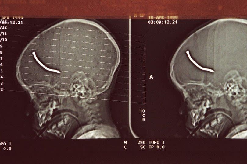 A 23-month-old boy was caught in the attack and a nail went through his skull