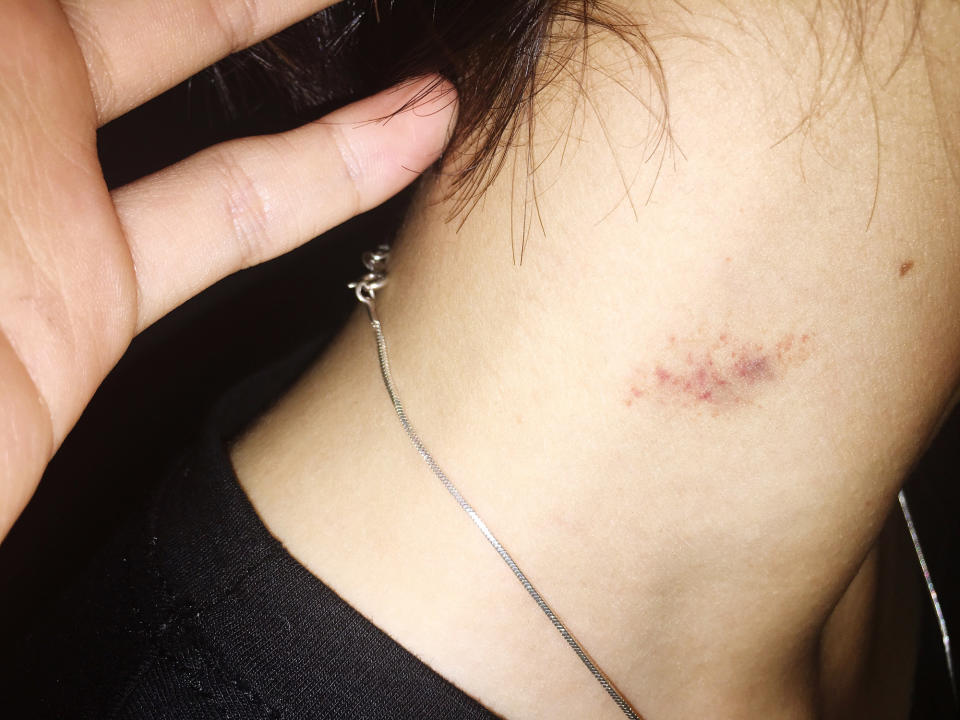 Close-up of a hickey on someone's neck