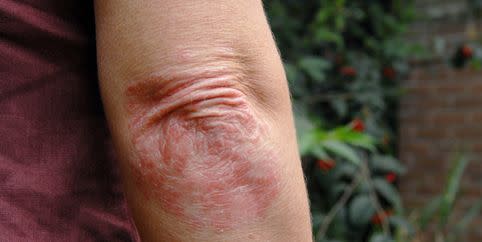 psoriasis