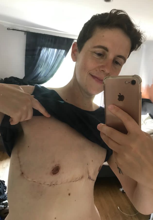 My boobs are so big I burnt them on Nando's grill but NHS still won't allow  me to have reduction op