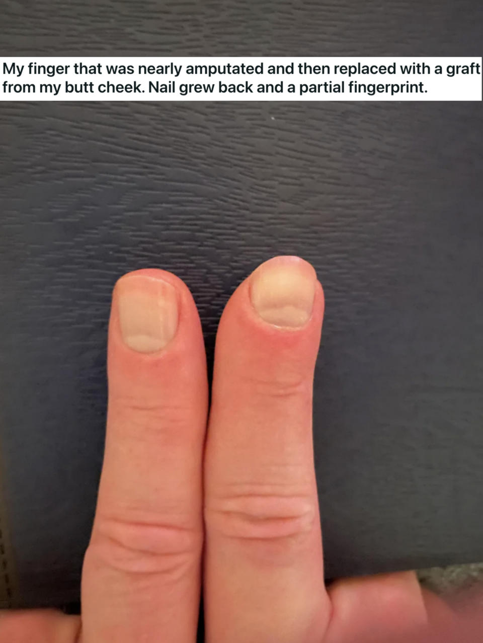 finger that got amputated and grew back with a nail next to their regular finger