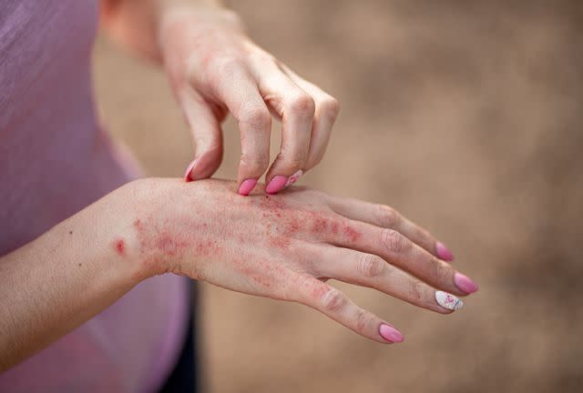 Types of Skin Rashes and How to Treat Them