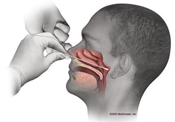 武漢肺炎的鼻咽檢測需用棉棒插入鼻腔底部採樣，許多人看畫面感到怵目驚心。（示意圖，翻攝自推特@DrPeckPNP）
