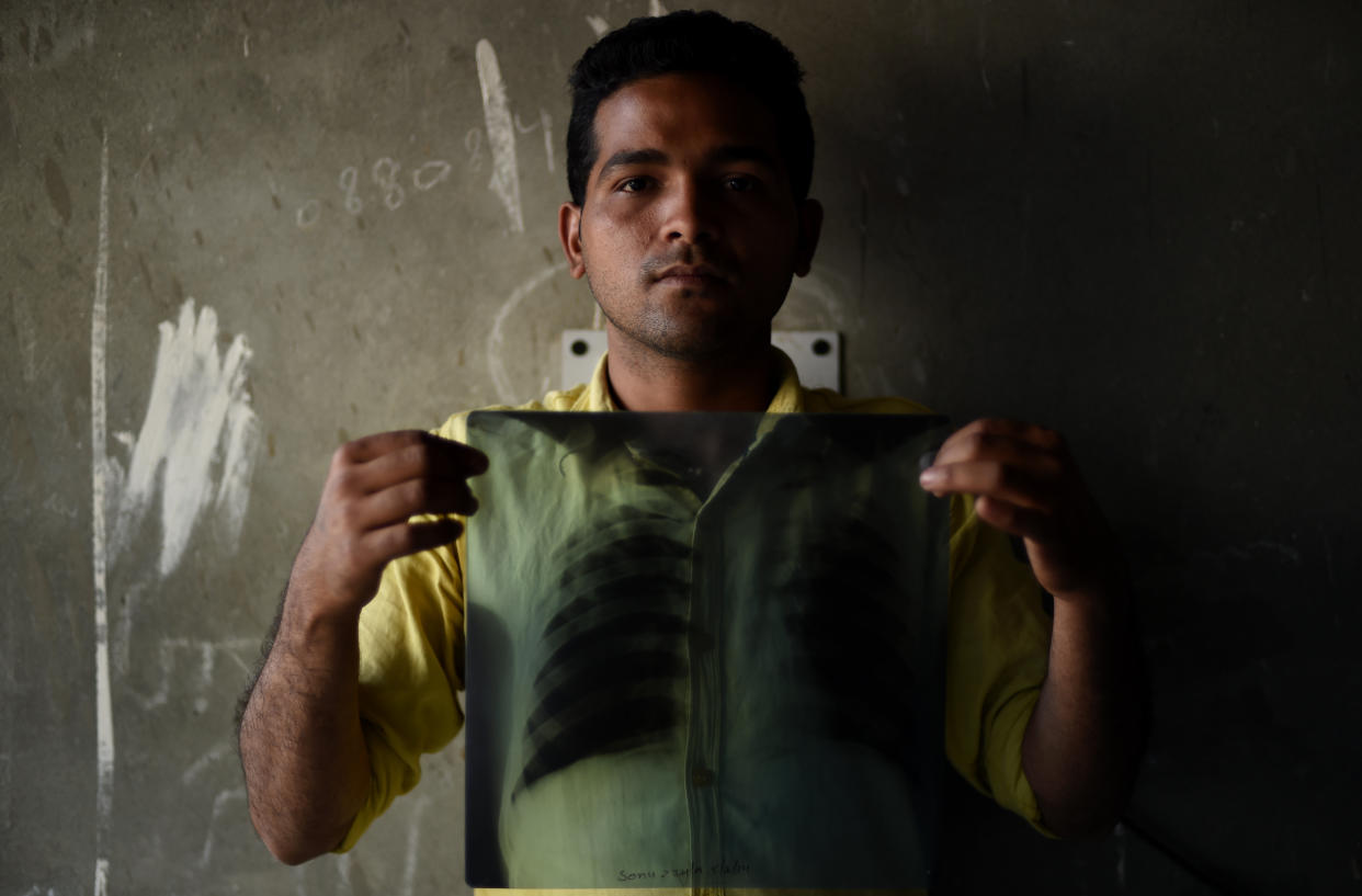 Indian tuberculosis patient Sonu Verma, 25, poses with his chest X-ray on March 3, 2016. (Photo: MONEY SHARMA/AFP/Getty Images)