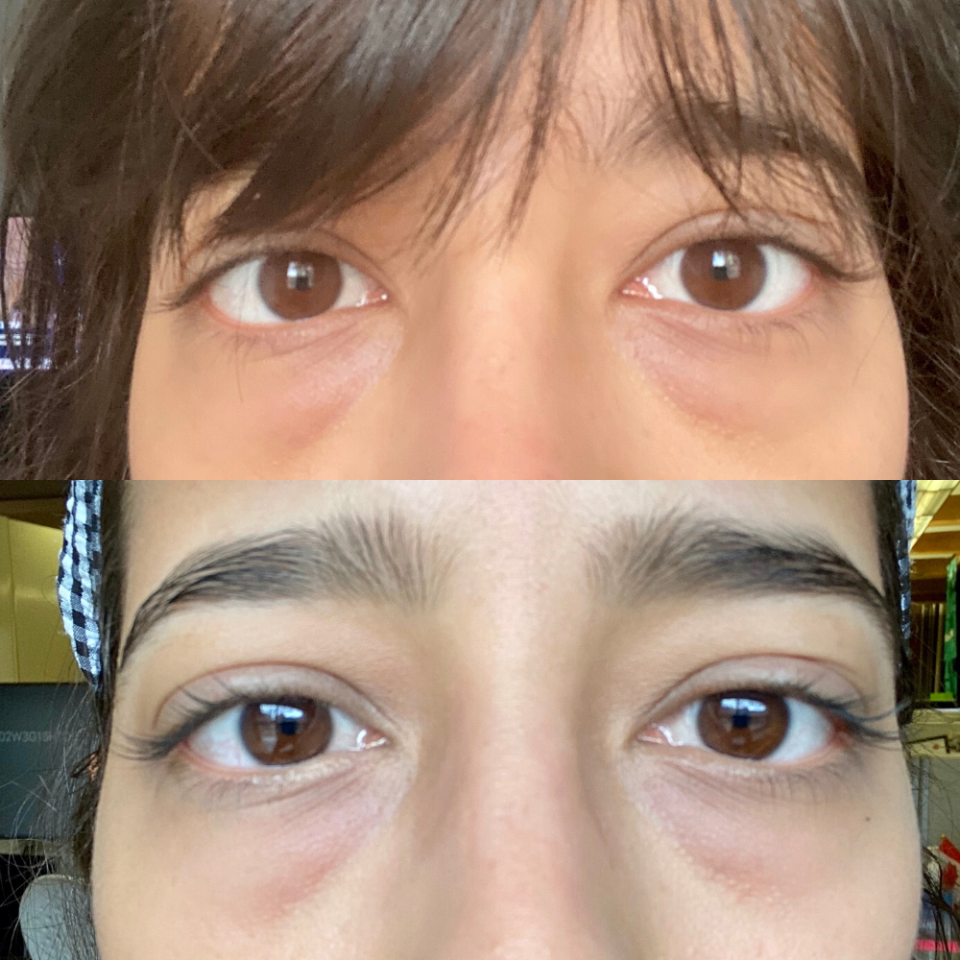 Before and after using the Dermalogica Biolumin-C Vitamin C Eye Serum. Feb 20 (top) vs. Mar 10 (bottom). 