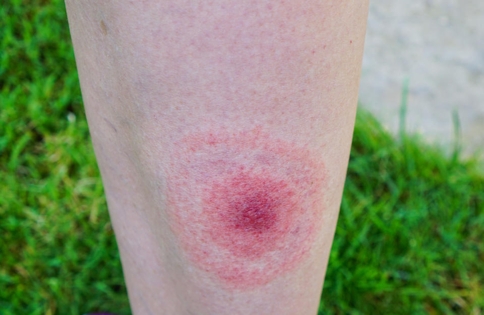 Lyme disease is often characterised by a 'bulls eye' rash (Getty Images)