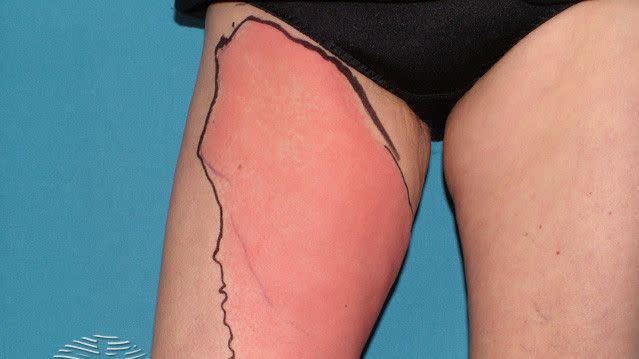 cellulitis skin rash