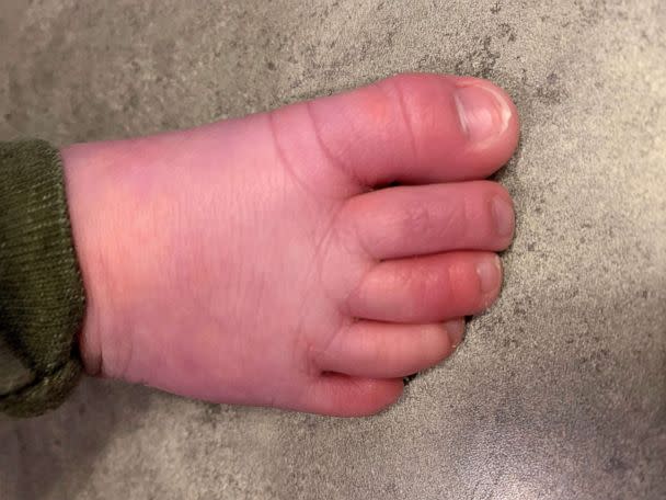 PHOTO: Sara Ward's 5-month-old Logan developed hair tourniquet syndrome in January and had to be rushed to the ER. This image shows his healed toe. (Sara Ward )