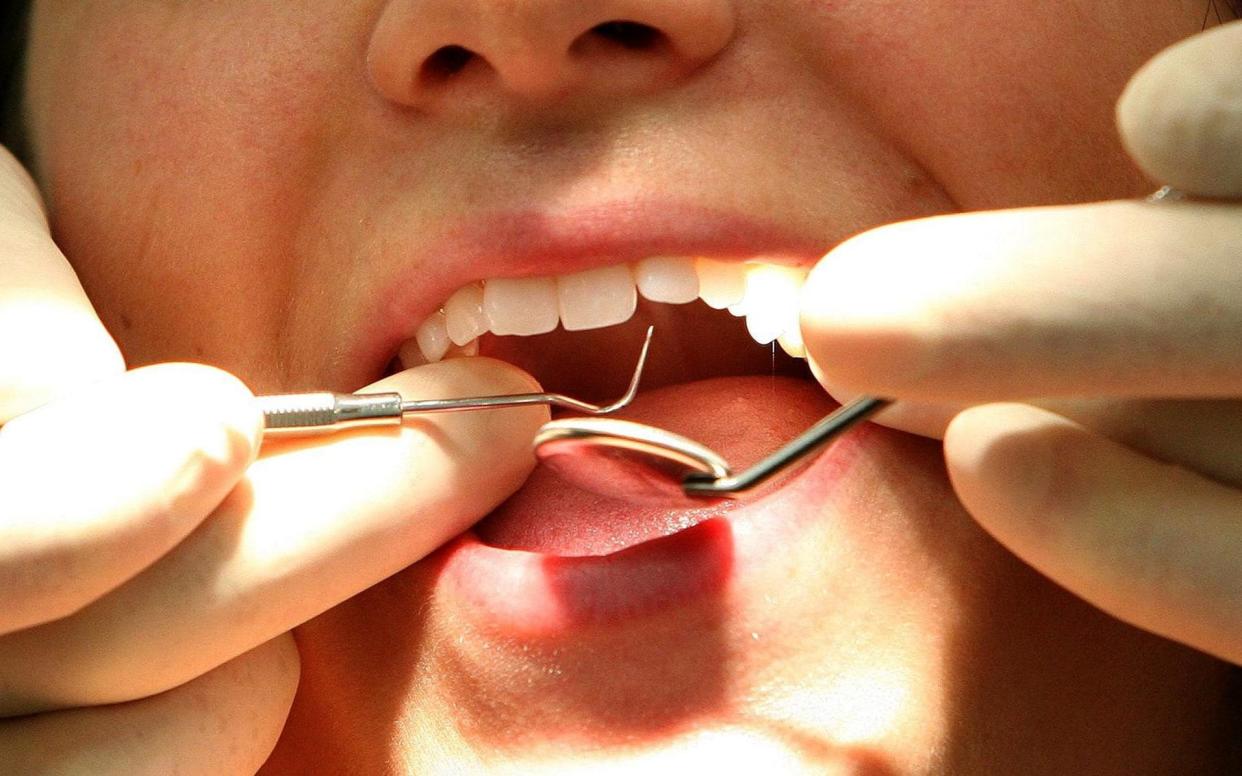Boots, the chemists, said that sales of at-home dental kits for lost fillings, caps and crowns were up by 87 per cent in the past three months of 2020, compared to the previous year - Martin Rickett/PA Wire