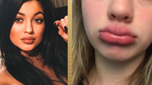 Alright, everybody! You can stop bruising your lips now. Many swollen mugs later, Kylie Jenner is responding to people trying to emulate her famous full-lip look. <strong>PICS: People Are Doing the 'Kylie Jenner Challenge' and the Results Are Hilariously Awful </strong> The 17-year-old <em>Keeping Up With the Kardashians</em> star tweeted: "I'm not here to try & encourage people/young girls to look like me or to think this is the way they should look. I want to encourage people/young girls like me to be YOURSELF & not be afraid to experiment w your look." I'm not here to try & encourage people/young girls to look like me or to think this is the way they should look. (Cont...)— Kylie Jenner (@KylieJenner) April 21, 2015 I want to encourage people/young girls like me to be YOURSELF & not be afraid to experiment w your look. ❤️❤️❤️— Kylie Jenner (@KylieJenner) April 21, 2015 <strong>NEWS: It Takes Kylie Jenner 40 Minutes a Day to Get Her Famous Lips </strong> See everybody? All you have to do is be yourself! Sorry if it's too late... just did the #kyliejennerchallenge wtf is wrong with me pic.twitter.com/rG9Tv62xSa— ✕ (@michellenajeraa) April 19, 2015 We guess the takeaway is that growth can be hard. Everything changes! Tumblr So YOU BE YOU. But seriously, don't mess around! Dermatologist Dr. Engelman talked to <em> The Insider</em> about the dangers of the "Kylie Jenner Challenge." <strong>WATCH: Kylie Jenner Tries Blue Eyes For Fun </strong> "You can put yourself at risk for permanent disfigurement," said Dr. Engelman. "I would certainly tell parents who see their children participate in this challenge that’s dangerous and really try to stop that behavior as quickly as you see it."