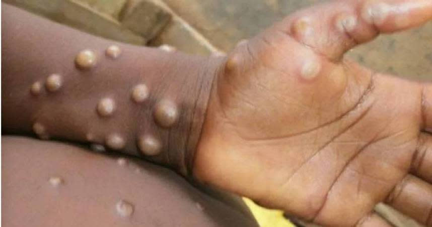 人體感染猴痘。（圖／翻攝自美國CDC官網）
