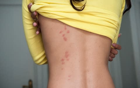 Bed bug bites can cause a rash - Credit: istock