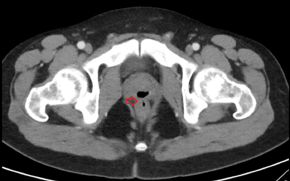 A CT scan of a gas-filled structure within the posterior aspect of the prostate. Source: Jam Press/Australscope