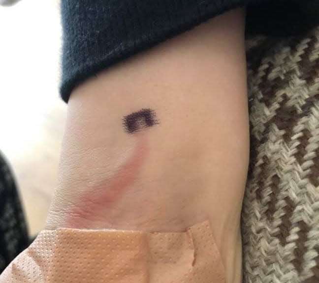 A U.K. mom noticed this red streak in her son's arm and took him to a weekend clinic. It turned out, he had sepsis.