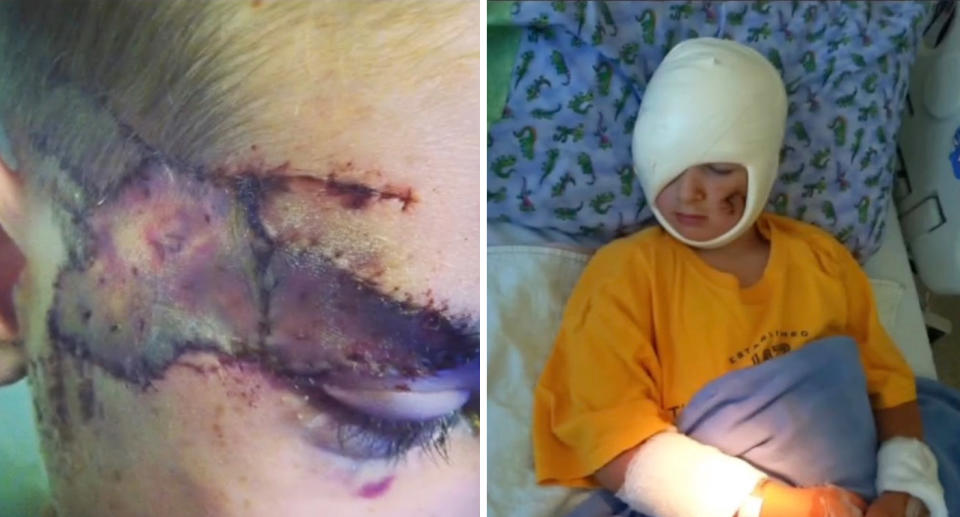 Hunter Kilbourn's facial scars after dog attack; Hunter in hospital with head bandaged