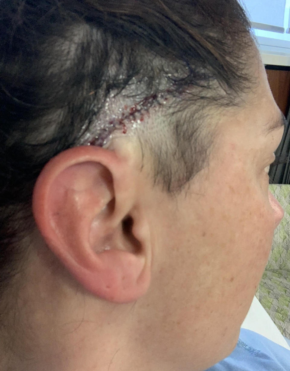 Lee King pictured with stitches in her head after one of three surgeries to remove the mole.