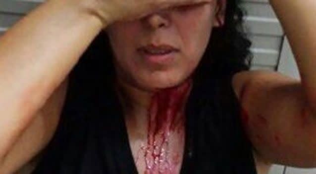 Iranian refugee Marjan was attacked last year in front of her home by two men who hit her with a metal bar. Source: Private