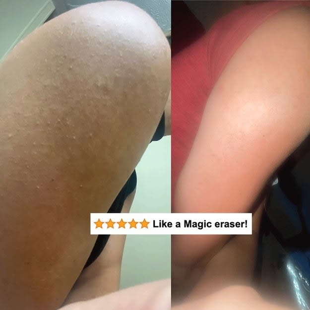 A reviewer's before/after showing the bumpy skin that's now smooth with five-star review text "like a magic eraser"