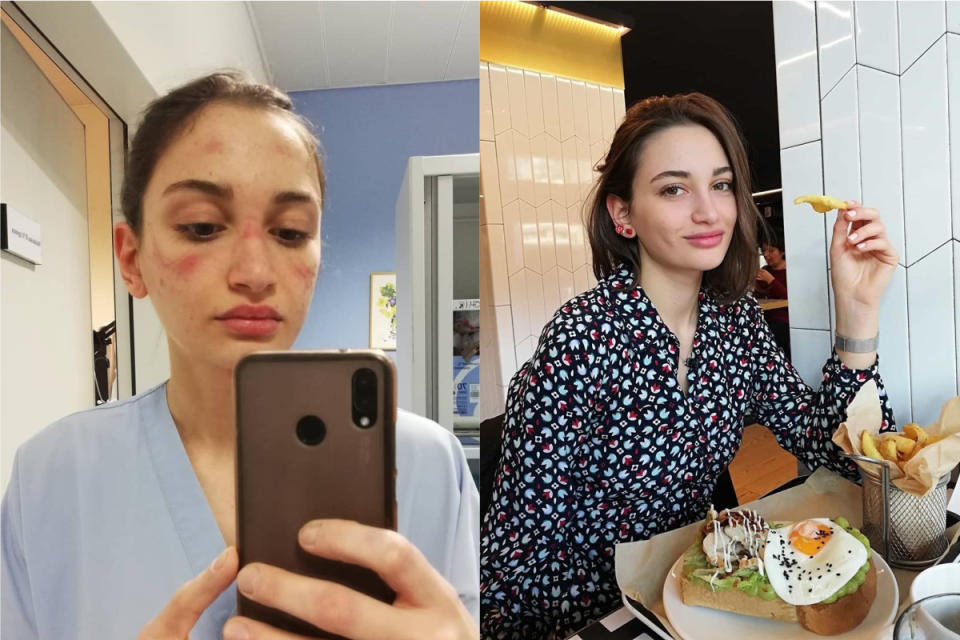 義大利急診護理師 Alessia Bonari 曬出自己因為戴護目鏡滿臉勒痕的照片。