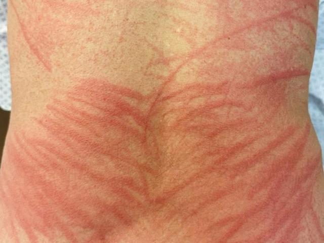 A man developed a rash that looked like something had scratched