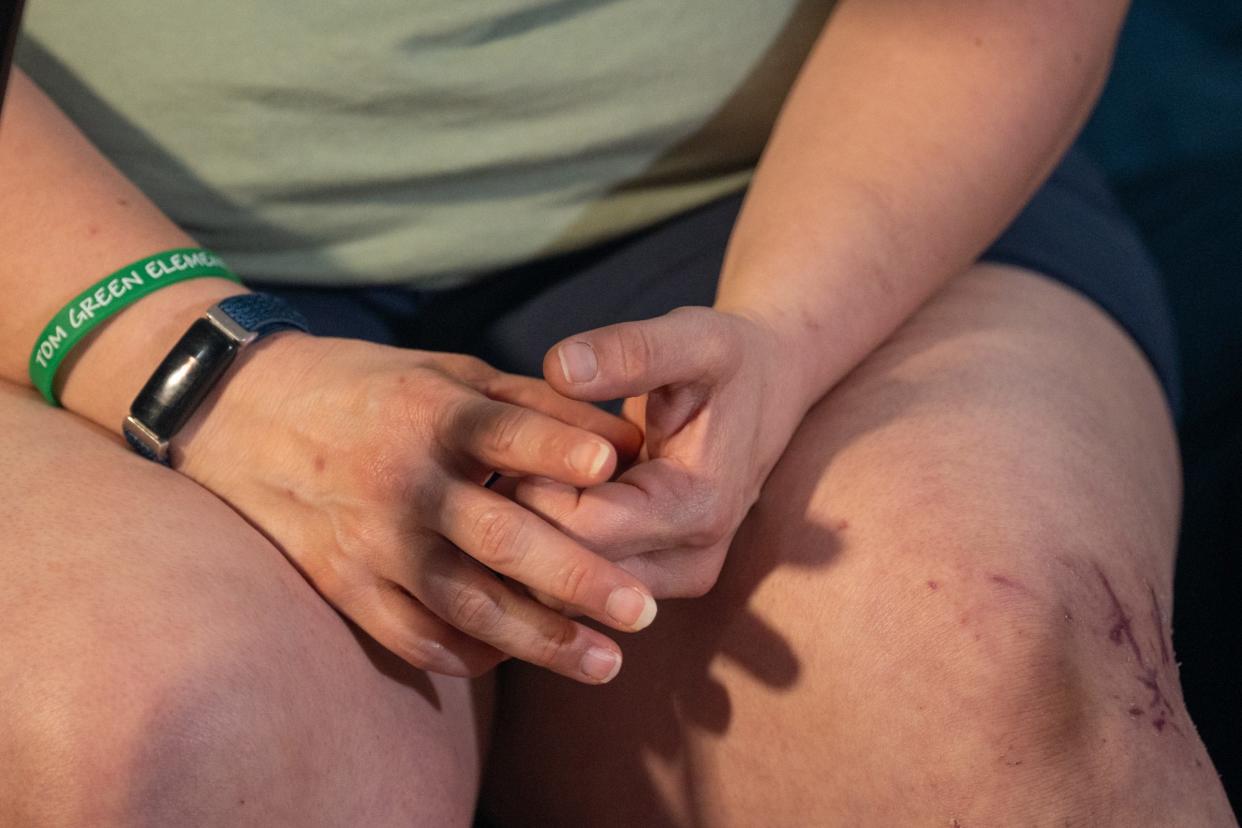 Cuts from glass are seen on Victoria Limon's legs as she discusses her experience as a passenger on the Tom Green Elementary bus crash as she sits at home on Wednesday, April 17, 2024. Limon, a teacher and a mother to a student on the bus, suffered fractures to four vertebrae in her lower lumbar and a bone contusion on her shin.