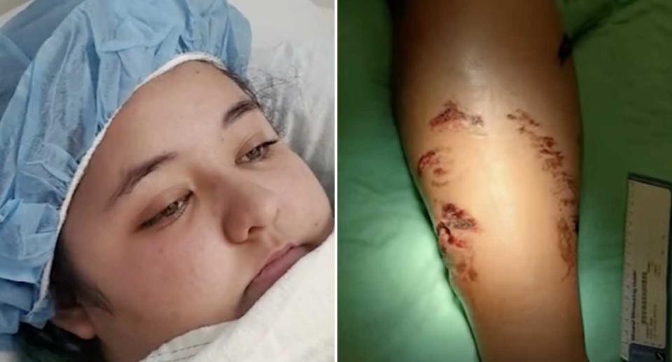 Kiana Hummel, 18, is pictured in hospital. Her injured leg is also pictured after a croc attack.