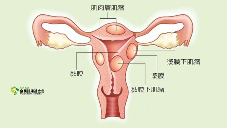 Uterine fibroids