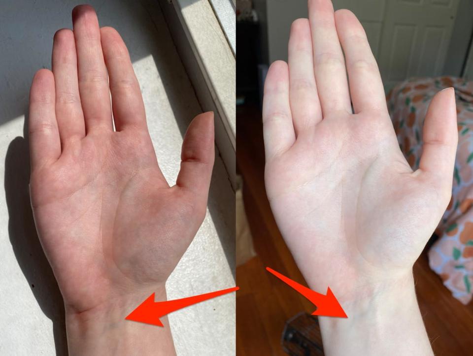 two photos of the authors hand with arrows pointing to wrist veins