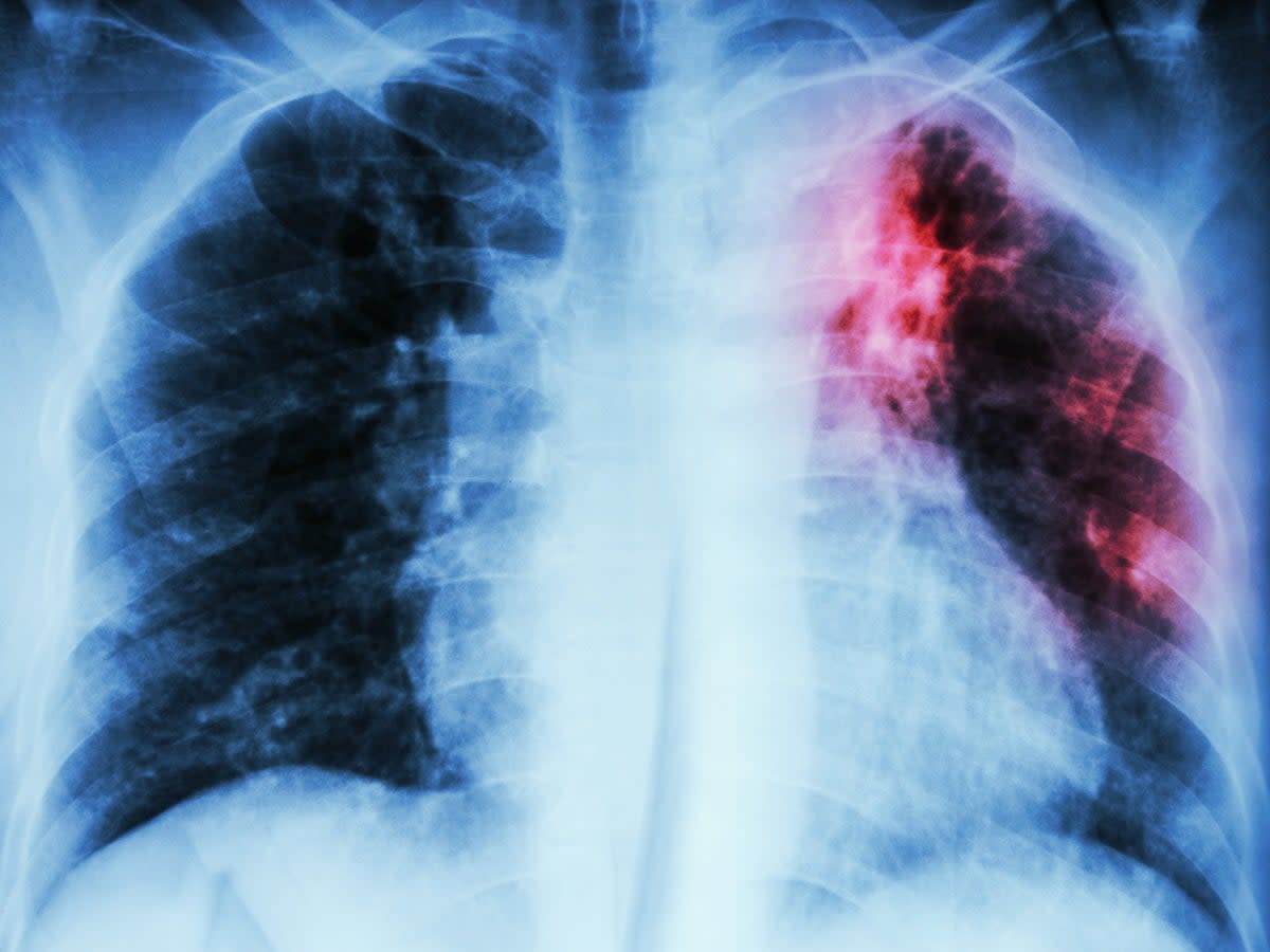 Tuberculosis deaths have risen in Europe for the first time in decades, according to a World Health Organisation report (Getty Images/iStockphoto)
