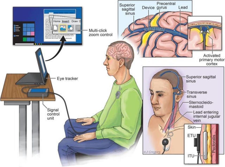 Synchron’s Stentrode device allows direct communication between a human brain and a computer, without the need for typing or speaking ((Journal of Neurointerventional Surgery))