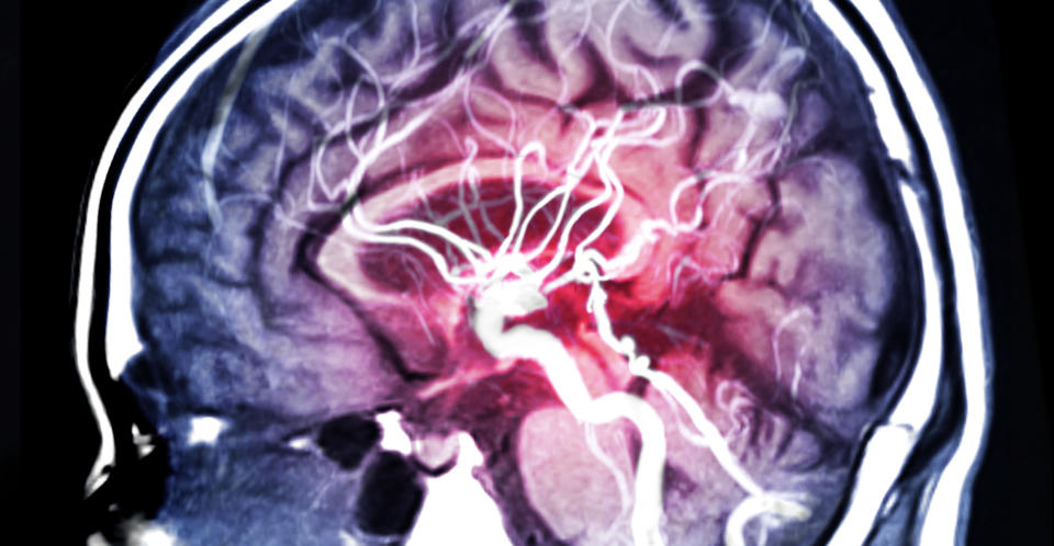 MRA Brain or Magnetic resonance angiography (MRI)  of Vessel in the brain sagittal view for evaluate them  stenosis (abnormal narrowing), occlusions, aneurysms (vessel wall dilatations, at risk of rupture) or other abnormalities. The Circle of Willis is a circle of vessels around the base of the brain where most aneurysms are found. (Getty Images)