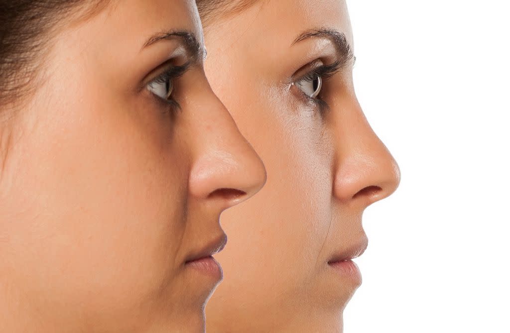 Rhinoplasty before and after