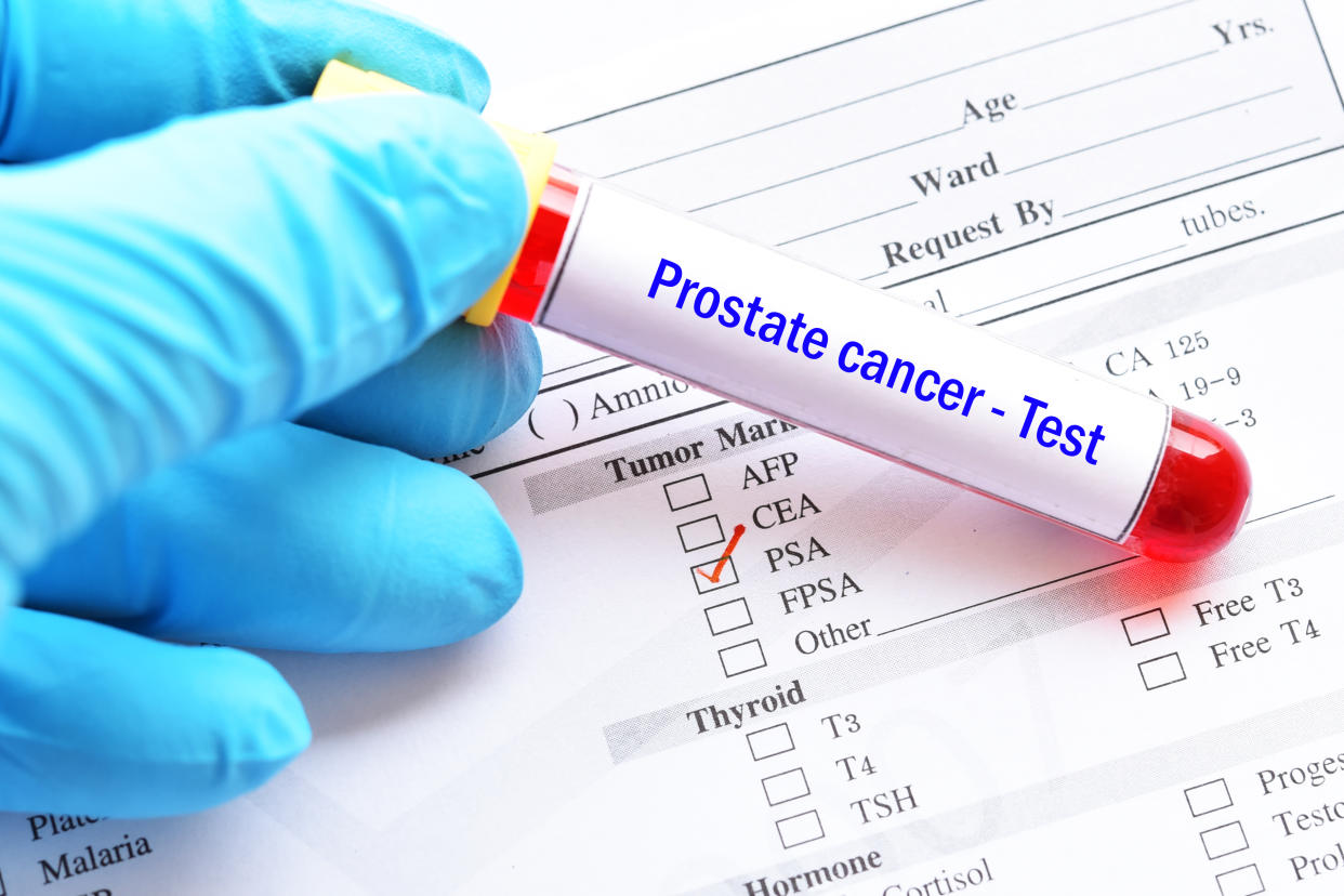 Blood sample tube with lab requisition form for PSA test, prostate cancer diagnosis