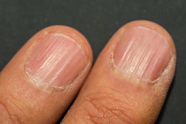 Ridges, known as onychorrhexis, tend to occur under your nails as you age. (Photo: Giuseppe Elio Cammarata via Getty Images)