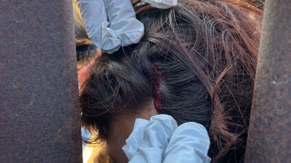 A humanitarian aid worker said she and other volunteers cleaned the wound a 15-year-old Guatemalan migrant sustained to her head when she fell as she crossed the border into California. - Courtesy Adriana Jasso/AFSC
