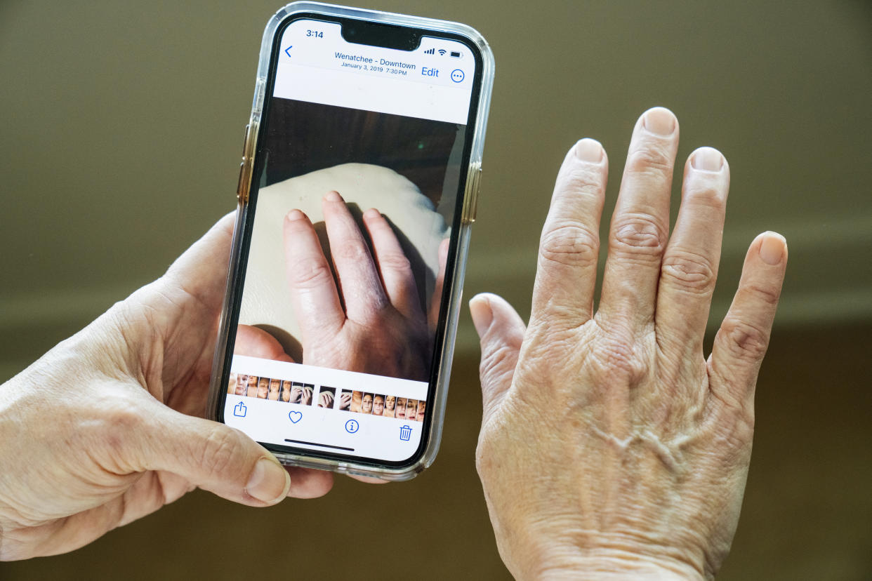 Lesa Walton compares her hand now to a photo when she experienced swelling and rheumatoid arthritis in 2019, at home in Wenatchee, Wash., June 3, 2024. (M. Scott Brauer/The New York Times)