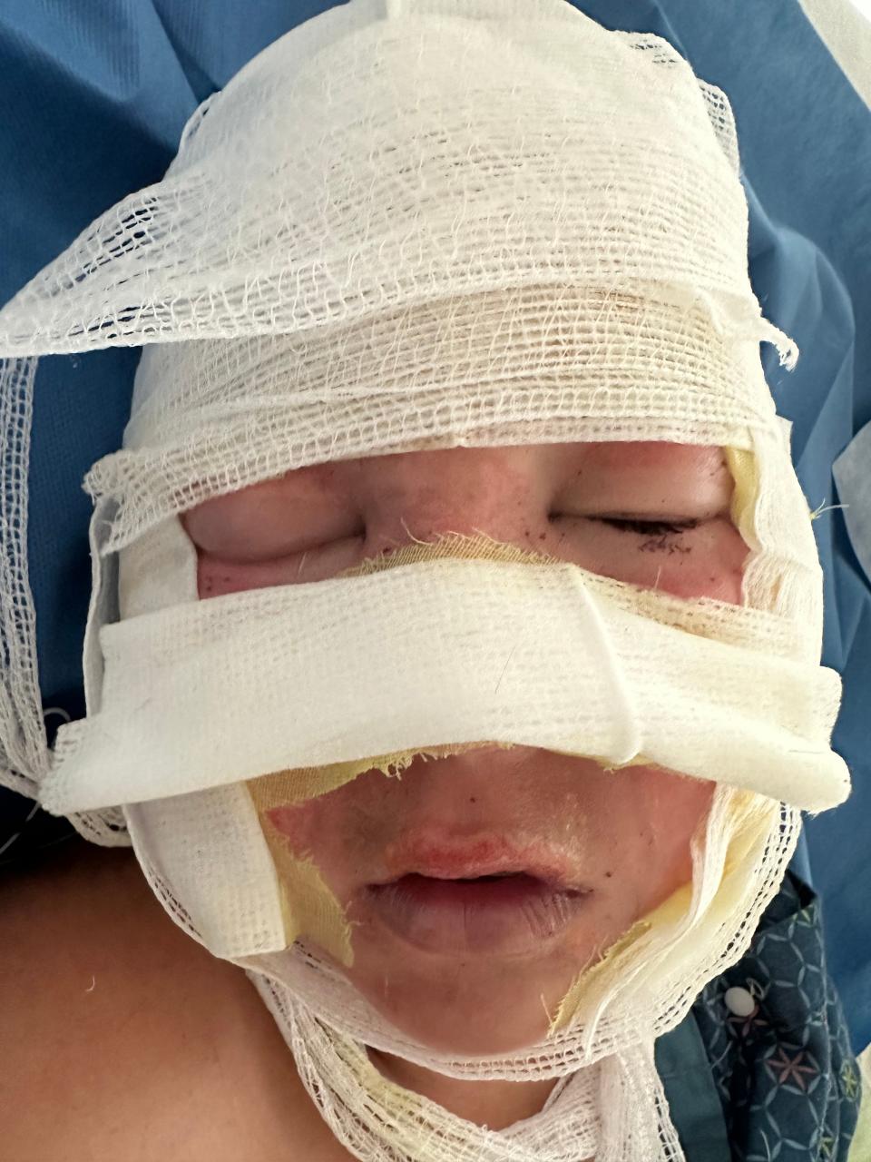 City resident Connor Snoke, 11, was severely injured on July 19 by an exploding aerosol can, but is expected to make a complete recovery. Connor wanted the Eagle-Gazette to publish this photo as a warning to other children.