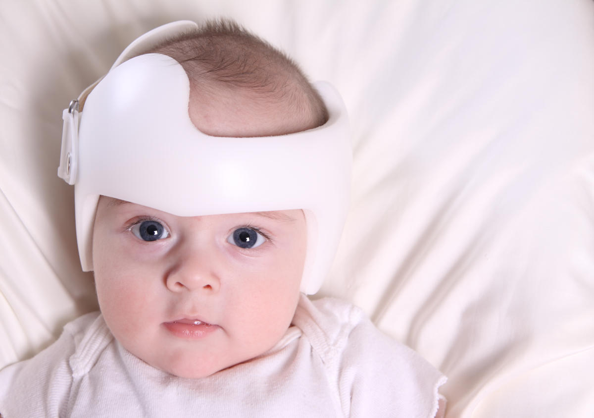 Su bebé debe usar casco por una enfermedad, así que toda la familia adoptó  la moda (FOTOS)