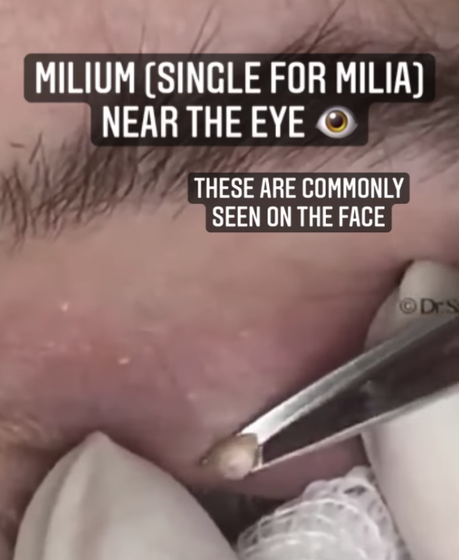 Photo credit: Dr. Pimple Popper/Instagram