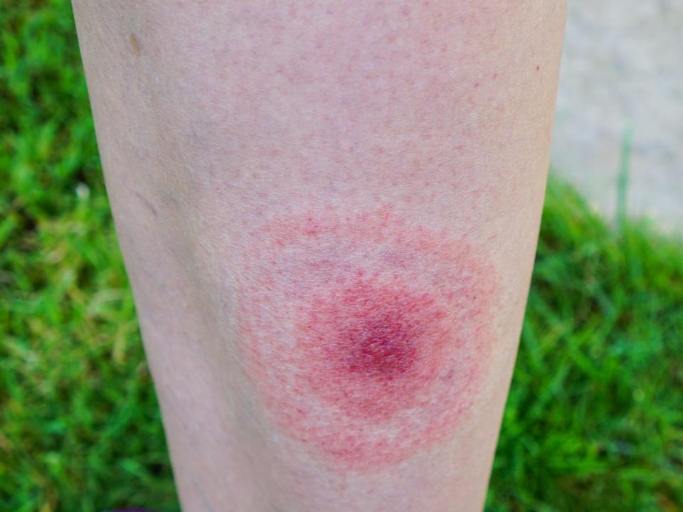 lyme disease