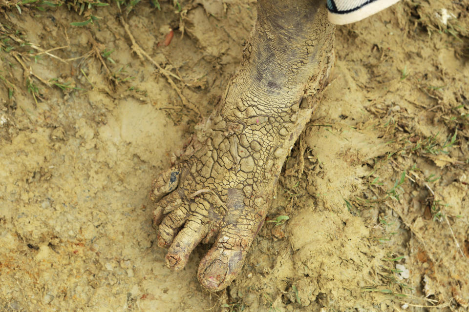 FILE - In this Monday, April, 29, 2019 file photo, a woman shows one of her feet after walking in the mud near a site where two houses were crushed by the collapse of a massive, sprawling dumpsite following rains from Cyclone Kenneth, in Pemba city on the northeastern coast of Mozambique. These African stories captured the world's attention in 2019 - and look to influence events on the continent in 2020. (AP Photo/Tsvangirayi Mukwazhi, File)