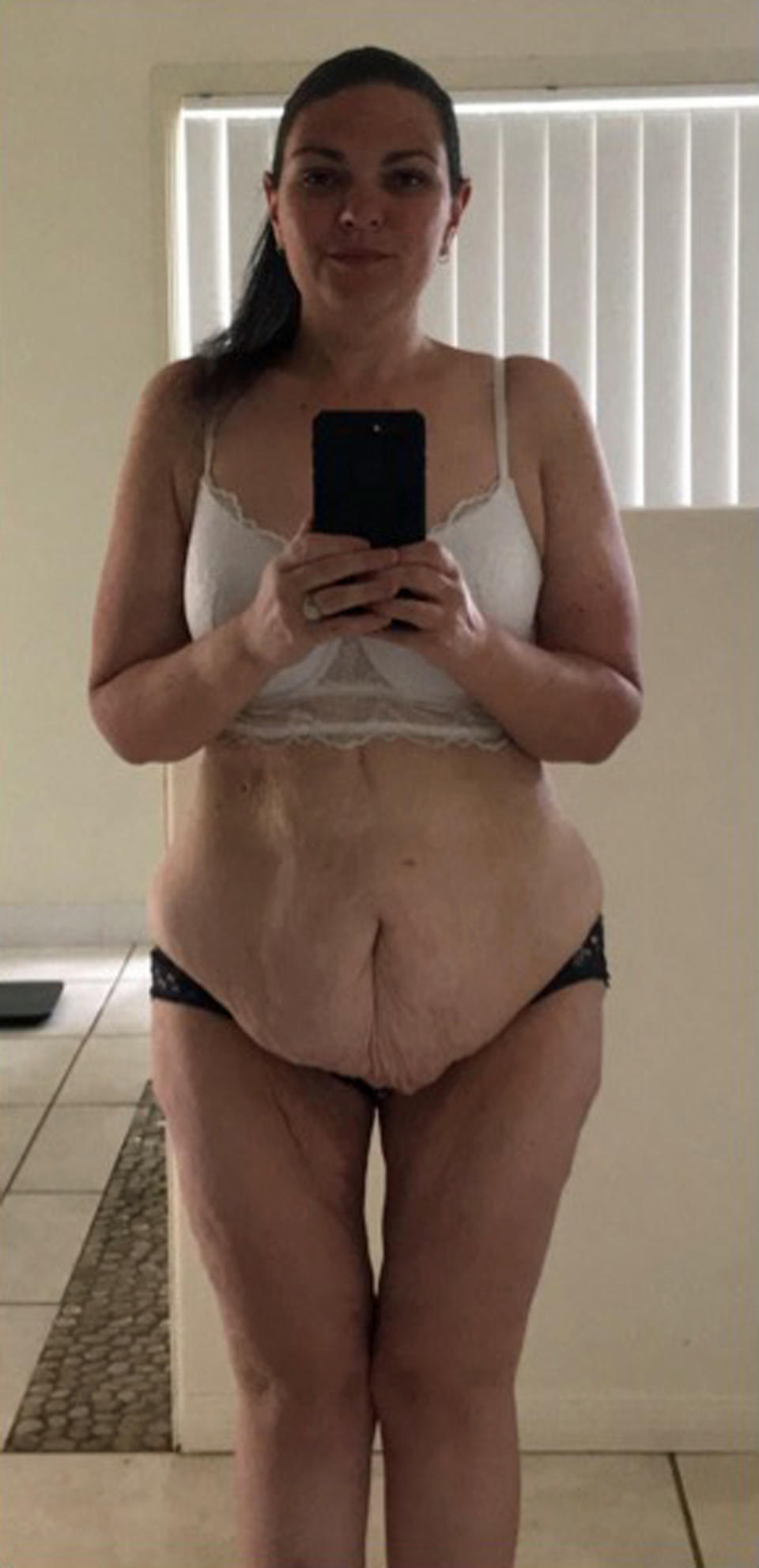 After undergoing gastric sleeve surgery, Veronica was still left with a lot of excess skin. Source: Caters