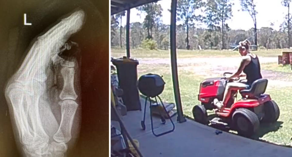 Right, Krichelle Parkinson can be seen riding her mower seconds before the mowing accident. Right, an Z-ray reveals she has lost her thumb. 