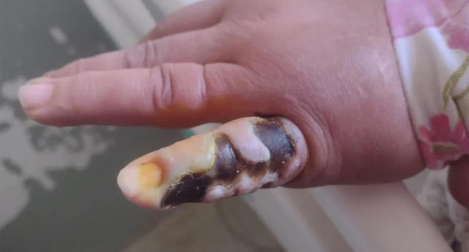 Photo showing woman's dead finger after recluse spider bite.