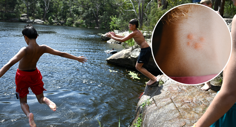 Background - children jumping into water. Inset - mosquito bites on a girl's neck.