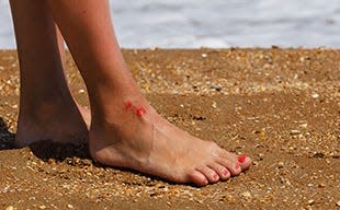 Open wounds while swimming in brackish waters is the primary way people are infected with Vibrio vulnificus.