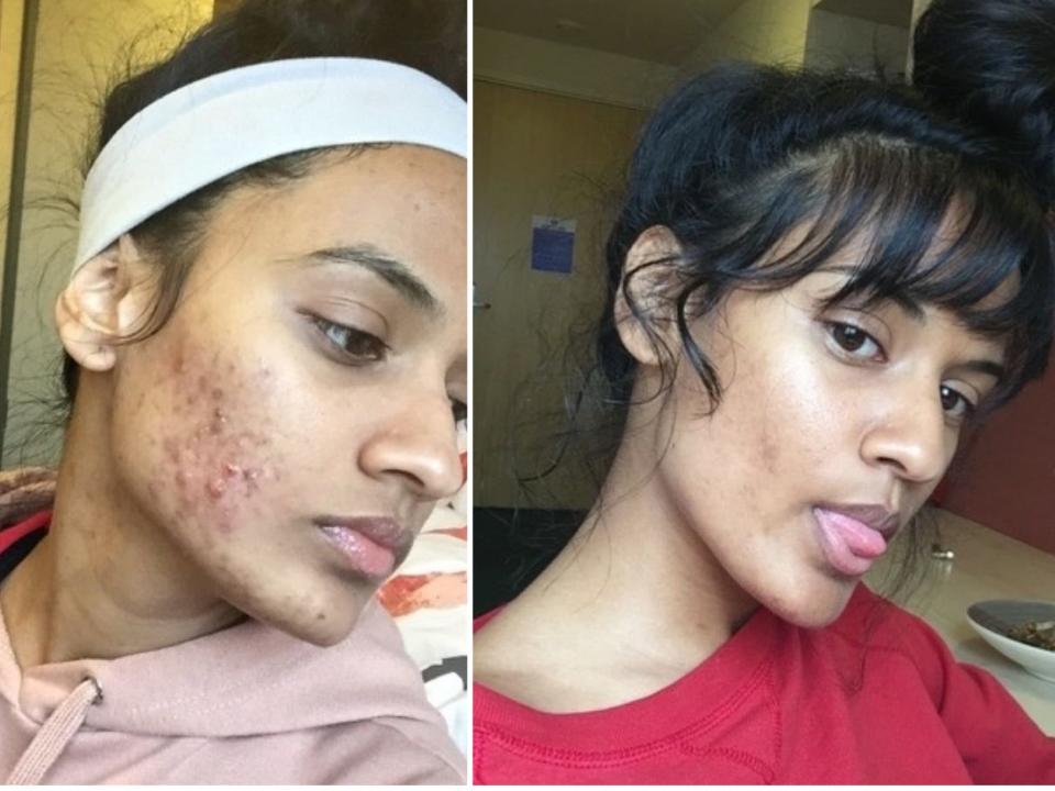 Sandy Singh, a woman with cystic acne, before treatment in 2016 and after treatment in 2017.