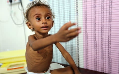 Malnourished Ferial Elias, 2, gestures as she is being weighed at a malnutrition treatment ward at al-Thawra hospital in Hodeidah - Credit: Reuters