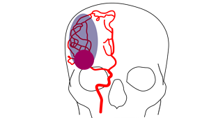 A clot in the brain vessel of a stroke patient leads to instant death of brain tissue closest to the clot, shown in dark pink. The larger area surrounding the core (shaded) is characterised as the penumbra, tissue which can still be rescued.