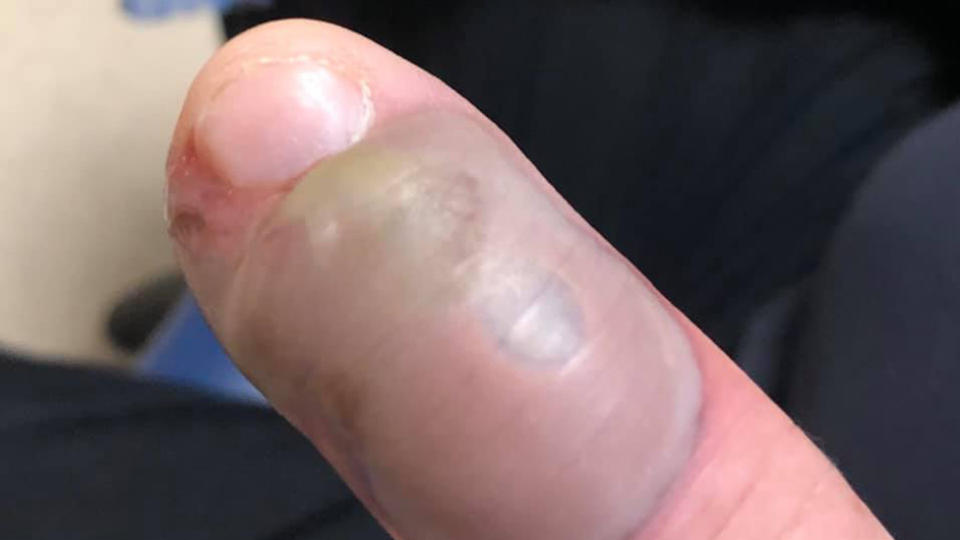 The man's finger is seen before treatment.